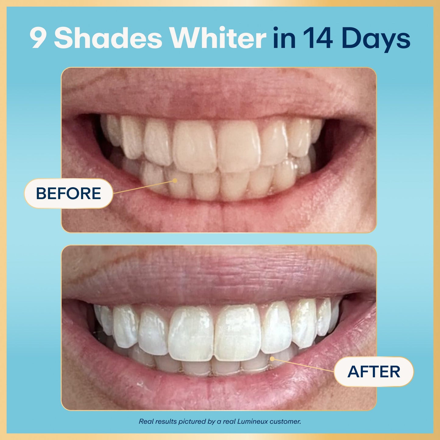Before-and-after teeth whitening results card with smiling mouth and brightened teeth