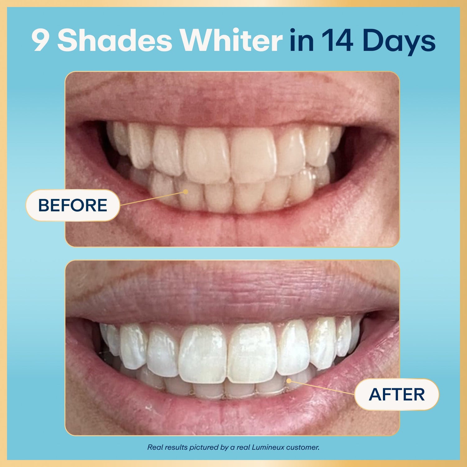 Before-and-after teeth whitening results card with smiling mouth and brightened teeth