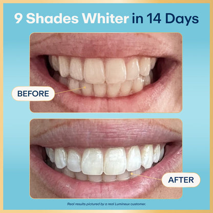 Before-and-after teeth whitening results card with smiling mouth and brightened teeth